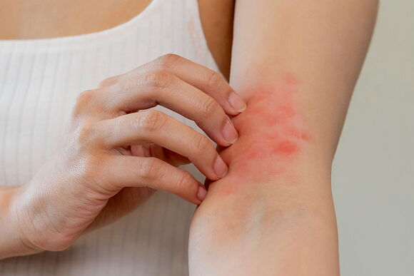 Eczema y el microbioma