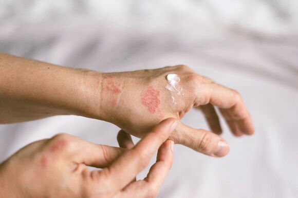 Eczema - Microbiome-friendly Standard
